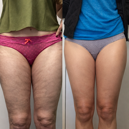 Oren™  Cellulite Massage Oil